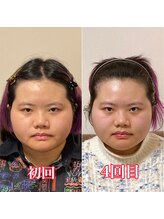 小顔22 ボルティ 赤坂支店(Bolty)/【悩み】丸顔・大きさ・むくみ