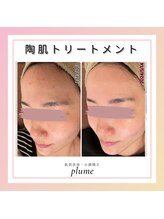プルーム 久留米店(plume)/ハーブピーリング