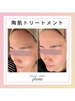 プルーム 久留米店(plume)/ハーブピーリング