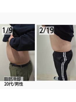 ゴールデンエイジ(Golden Age)/脂肪冷却 20代 男性【痩身】