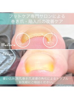 エッセンス (Essence)/巻き爪,陥入爪の予防,改善ケア