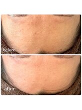 ビオエル 福岡(BIOEL)/韓国ハーブ　肌荒れ・ざらつき