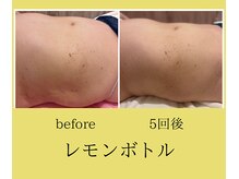 クリニカルエステ イーズ イオンモール筑紫野店/レモンボトルお腹の変化