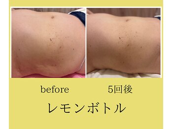 クリニカルエステ イーズ イオンモール筑紫野店/レモンボトルお腹の変化