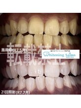 ホワイトニングサロン 福岡天神店/ホワイトニング