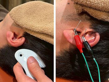 茅場町鍼灸マッサージ整骨院の写真/【耳の電気鍼＋ヘッドマッサージ】耳に鍼を打ち鍼に電気を流すことで、自律神経を整えて、睡眠の質向上！