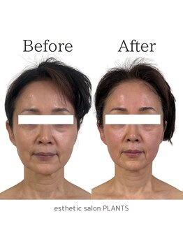 プランツ(PLANTS)/60代／１回／たるみ改善・小顔