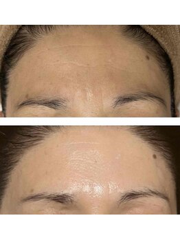 アドビューティ(Add Beauty)/≪小顔リフト／シワたるみ改善≫