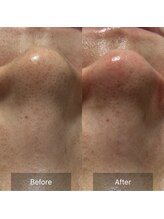 マヴィ(Mavie)/韓国式3D毛穴洗浄