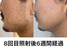 エナ バイ アオヒゲ(ena by AOHIGE)/ヒゲ脱毛　