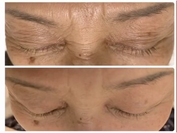 アリガトウ サロン シンパシー(A.Salon Sympathy)/ヒアルロン酸コラーゲン真皮導入