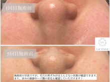 ラヴィオーラ 福島野田店(La Viora)/ダイヤモンドハーブピーリング