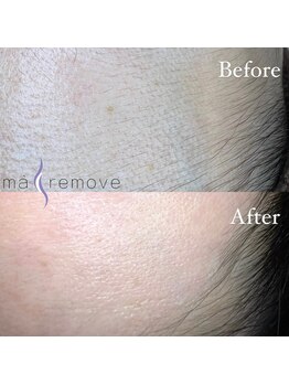 アイルームミラ 恵比寿店(mira)/マリムーブフェイシャルワックス