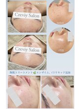 クレヴィー(Creviy)/積み重ねて手に入る陶器肌♪