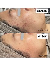 ココン(cocon)/肌改善