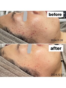 ココン(cocon)/肌改善