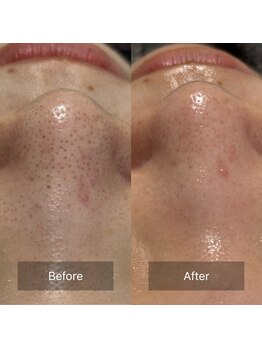 マヴィ(Mavie)/韓国式3D毛穴洗浄