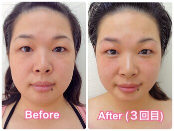 まこと鍼灸院/30代女性月イチメンテ3回目