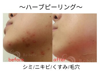 エール シガ(AILE SHIGA)/【ハーブピーリング】