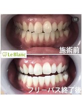 ルブラン 奈良店(Le Blanc)/ホワイトニングで若々しく！