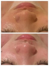 アムール(Amour)/毛穴洗浄