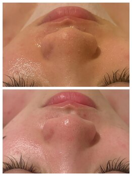 アムール(Amour)/毛穴洗浄