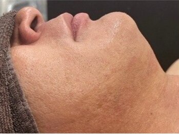 マイセルフ 福山神辺店(Myself)の写真/【毎朝の髭剃りから解放!】カミソリ負け・青髭のお悩みに。広範囲照射のメンズ脱毛で清潔感のある素肌へ。