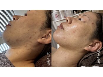 レイ(Lei)/ニキビ/毛穴/ハーブピーリング