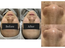 ザセイム(THE Same)/ハーブピーリング