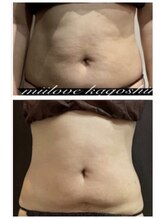 ミーラブ 鹿児島(miilove)/40代ぽっこりお腹引きしめ