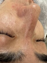 リコリス(Lycoris)/毛穴洗浄