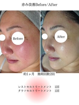 ルノン(LUNON)/赤みBefore/After