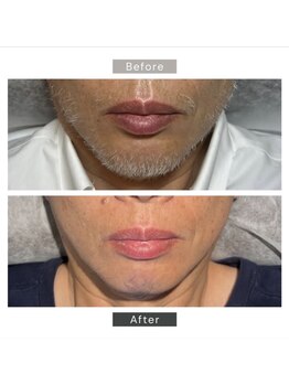 シーボウ(CBOU)/美容電気脱毛(白髭)