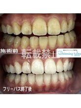 ホワイトニングサロン 福岡天神店/ホワイトニング