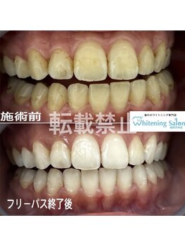 ホワイトニングサロン 福岡天神店/ホワイトニング