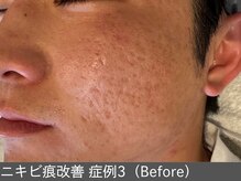 オアシスラグーン(OASIS LAGOON)/ニキビ後の凹凸（症例3 before）