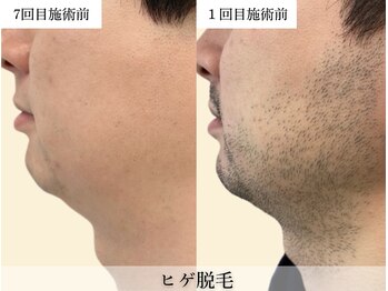 レオンザビューティー(REON the BEAUTY)/症例写真│ヒゲ脱毛