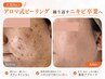 【跡・毛穴・ニキビケア】マイクロニードルピーリング◎18000⇒16500/越谷
