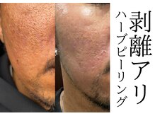 サロン イナンナ(Salon INANNA)/凹凸肌/陥没毛穴を改善♪