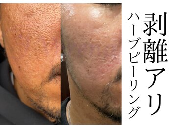 サロン イナンナ(Salon INANNA)/凹凸肌/陥没毛穴を改善♪