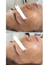 スターリー ラッシュ(Starry Lash)/韓国発ダイヤモンドピーリング