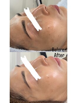 スターリー ラッシュ(Starry Lash)/韓国発ダイヤモンドピーリング