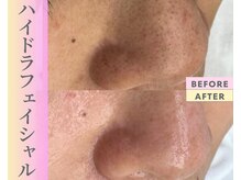 Cスキンケアクリニック 麻布店/毛穴洗浄BeforeAfter