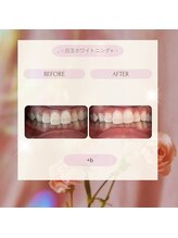 プラスビーセルフ(+b self)/ホワイトニングビフォーアフター