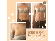 ハチカラット(8carat)/before after ３人目１