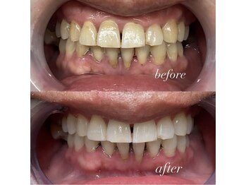 ホワイトニングセンター 大阪羽曳野店/最近の歯科ホワイトニングお客様