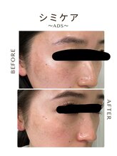 ツヤハダコガオ 千葉店/before⇒afteｒ 【シミケア】