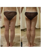 ルノン(Lunon)/《歪み改善》O脚ケア