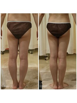 ルノン(Lunon)/《歪み改善》O脚ケア