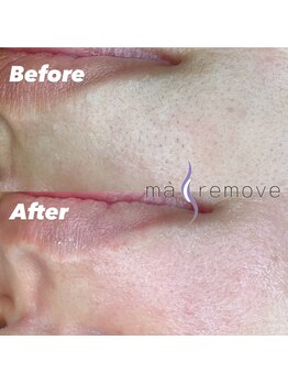 アイルームミラ 恵比寿店(mira)/マリムーブフェイシャルワックス